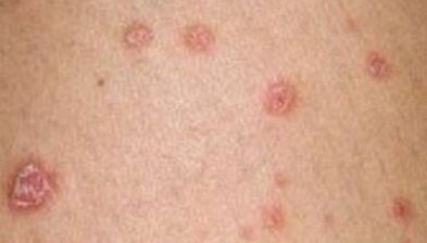 fotografia psoriázy v počiatočnom štádiu