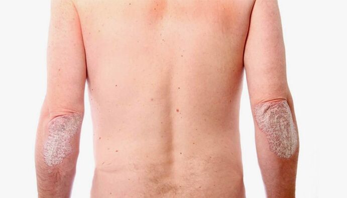 ľudové lieky na liečbu psoriázy