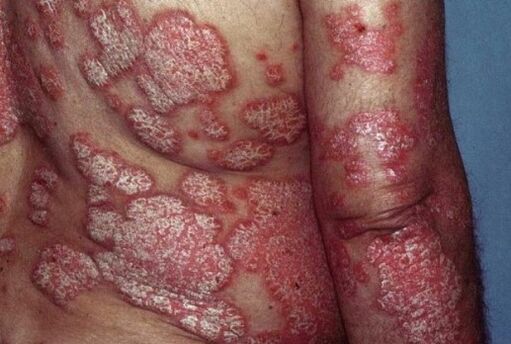 Psoriáza