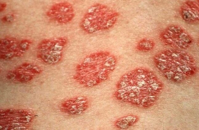Psoriatické papuly