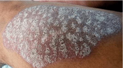 Patogenéza psoriázy