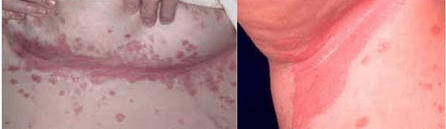 Atypická forma psoriázy