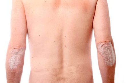Všeobecné príznaky psoriázy
