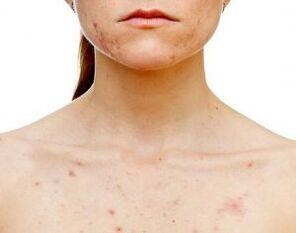 Na ktorých častiach tela sa psoriáza objavuje