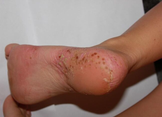 Palmoplantárna psoriáza