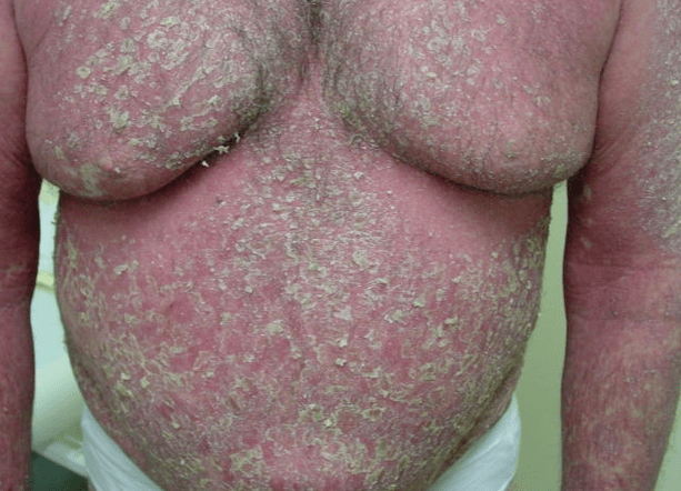 Psoriatická erytrodermia na tele