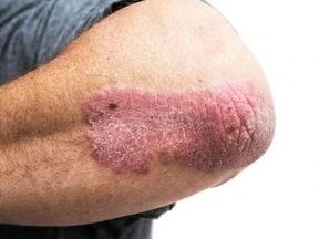 Psoriáza s plakmi na lakti