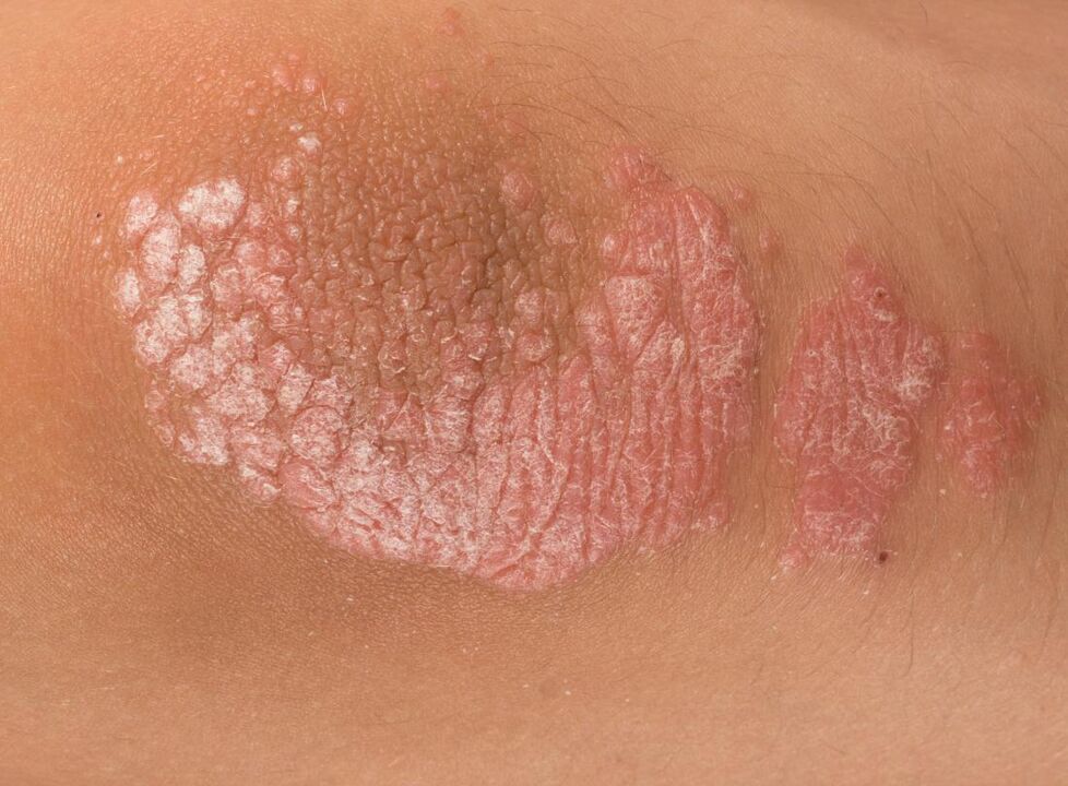 Psoriáza